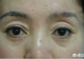 眼窝凹陷有黑眼圈怎么办？