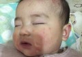 五个月的宝宝对牛奶卵白过敏，需要回避奶成品，全母乳15天后起了湿疹，是不是宝宝对母乳也过敏呢？